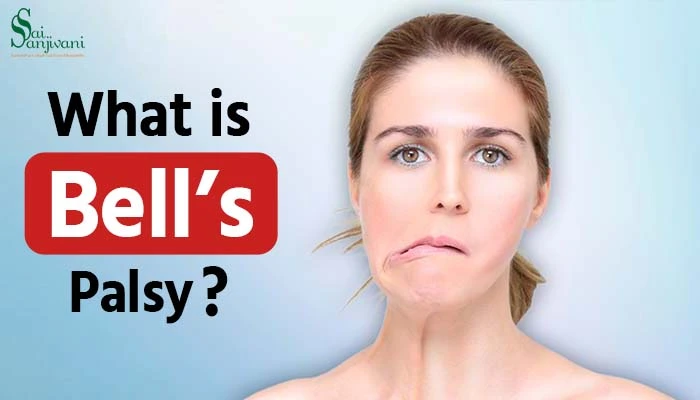 What is Bell’s Palsy?