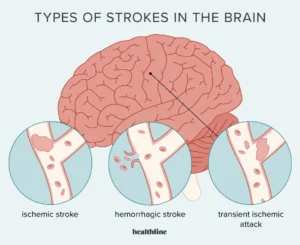 paralysis attack symptoms ischemic stroke